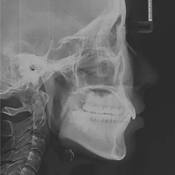 Rayons X avant le traitement