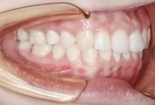 Photos intra-orales après traitement