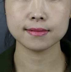 Photos faciales avant le traitement