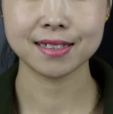 Photos faciales avant le traitement