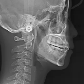 Rayons X avant le traitement