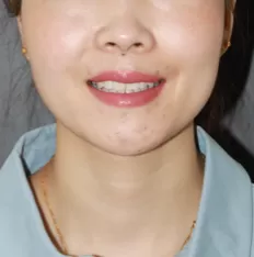 Photos faciales avant le traitement