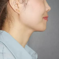 Photos faciales avant le traitement