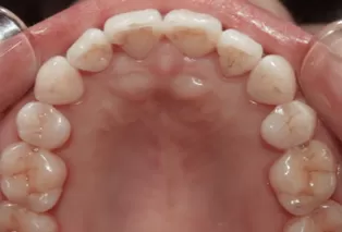 Photos intra-orales après traitement