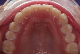 Photos intra-orales après traitement