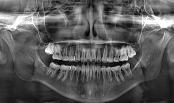 Rayons X avant le traitement