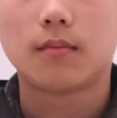 Photos faciales avant le traitement