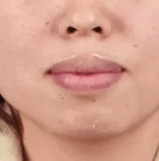 Photos faciales avant le traitement