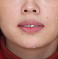 Photos faciales avant le traitement