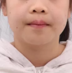 Photos faciales avant le traitement