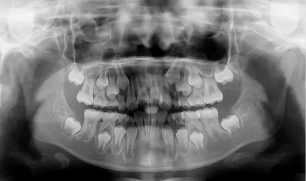 Rayons X avant le traitement