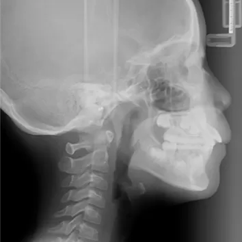 Rayons X avant le traitement