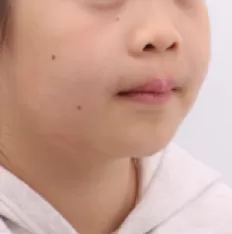 Photos faciales avant le traitement