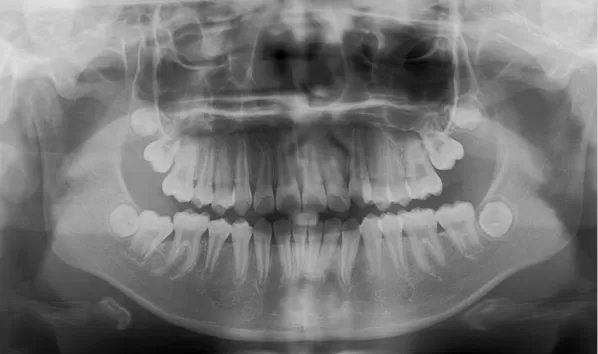 Rayons X avant le traitement