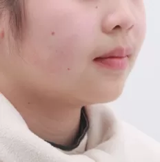 Photos faciales avant le traitement