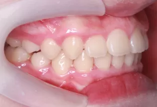 Photos intra-orales après traitement