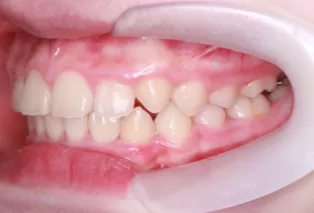 Photos intra-orales après traitement