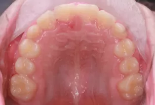 Photos intra-orales après traitement