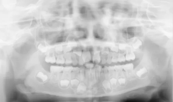 Rayons X avant le traitement