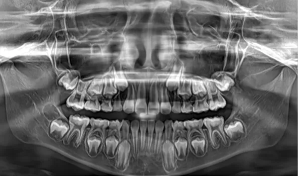Rayons X avant le traitement