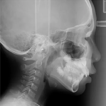 Rayons X avant le traitement