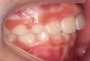 Photos intra-orales après traitement