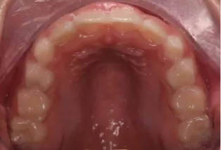 Photos intra-orales après traitement