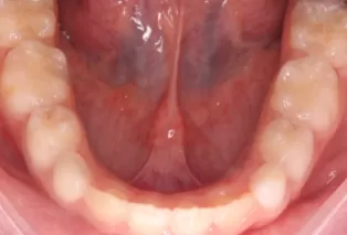 Photos intra-orales après traitement