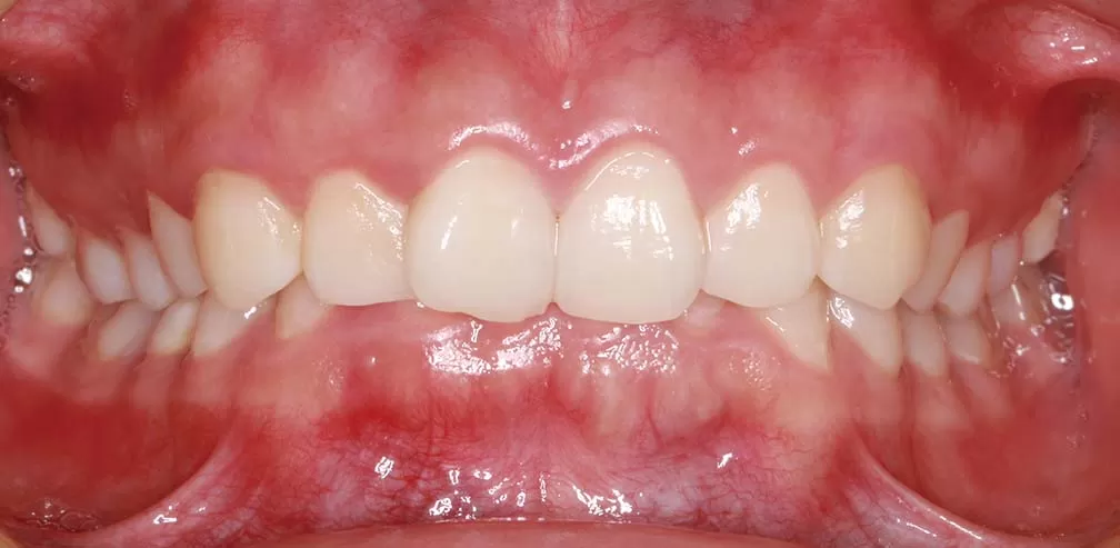 S8-SGTB l'avancement mandibulaire