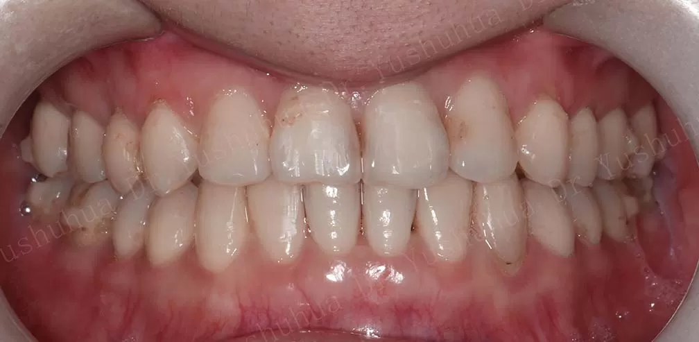 S10 Corriger la crosse antérieure