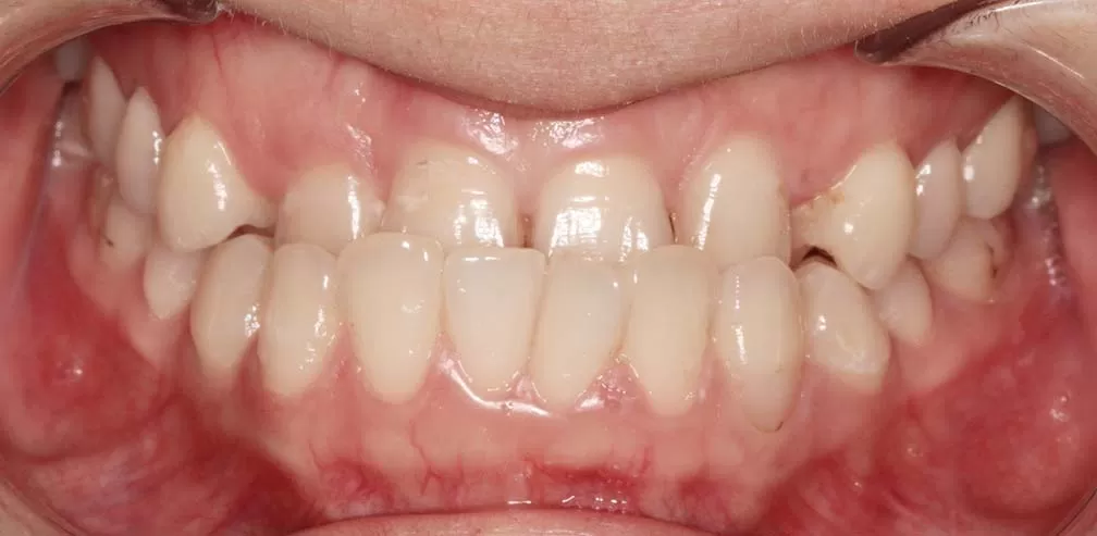 S10 Corriger la crosse antérieure