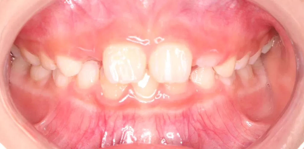 Smartee Kinder-Deep Overjet, 7 ans