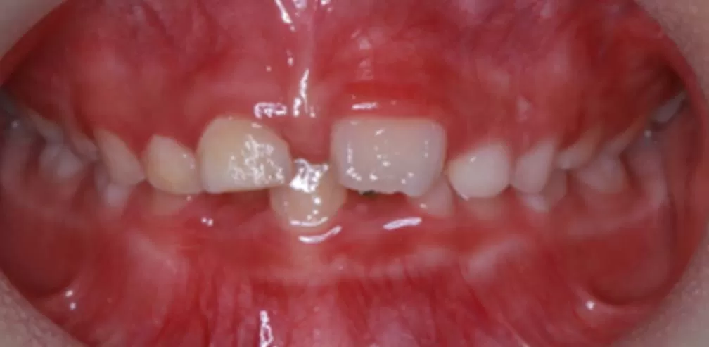 Smartee Kinder-Deep Overjet, 7 ans