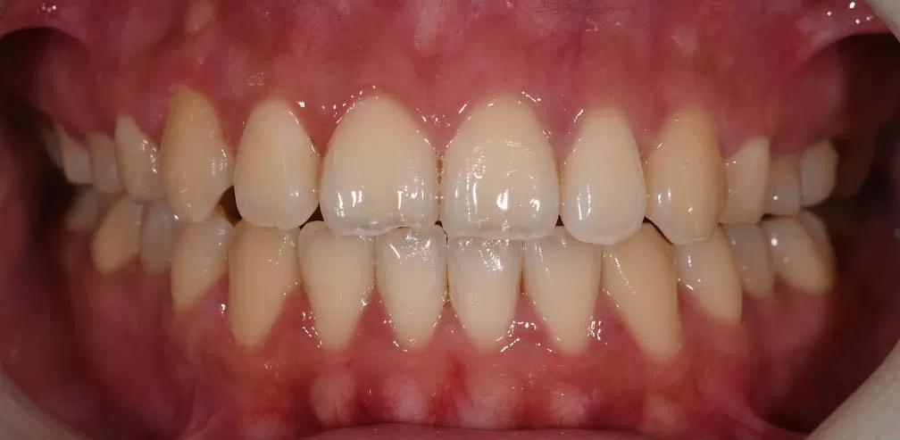 S8-SGHB l'ouverture antérieure correcte