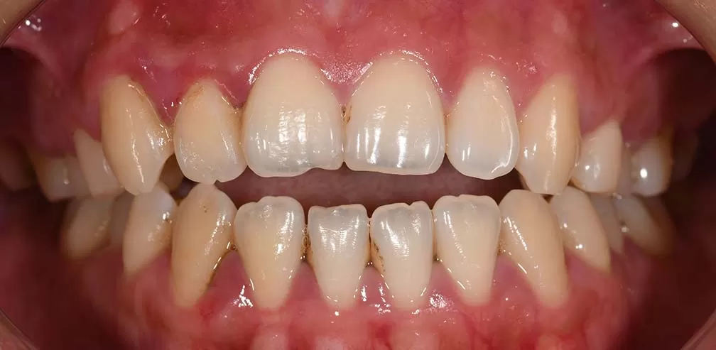 S8-SGHB l'ouverture antérieure correcte