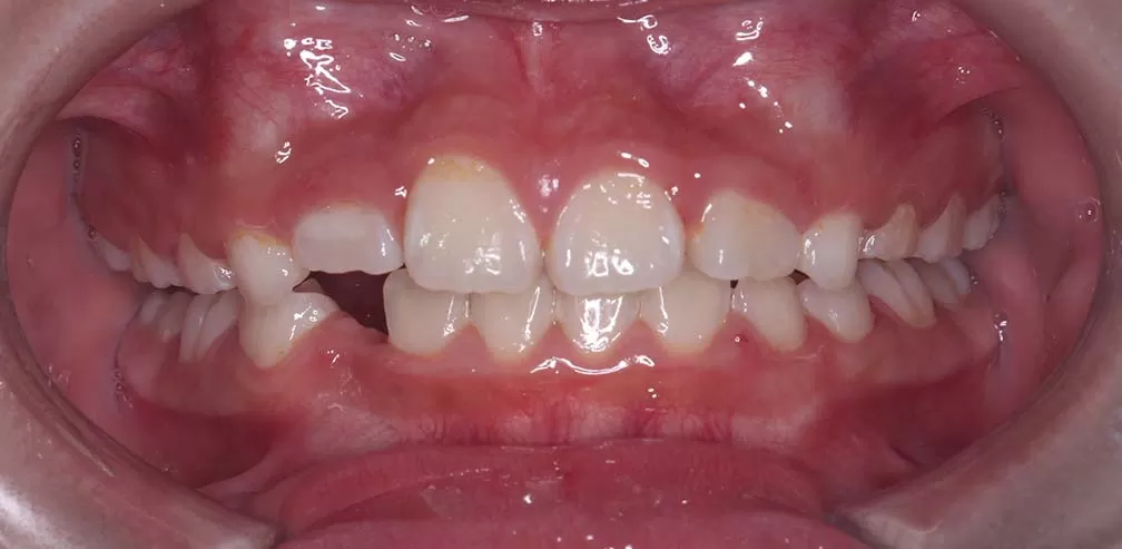 Smartee Kinder-Ectopia à dents individuelles