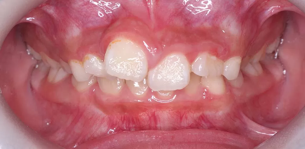 Smartee Kinder-Ectopia à dents individuelles