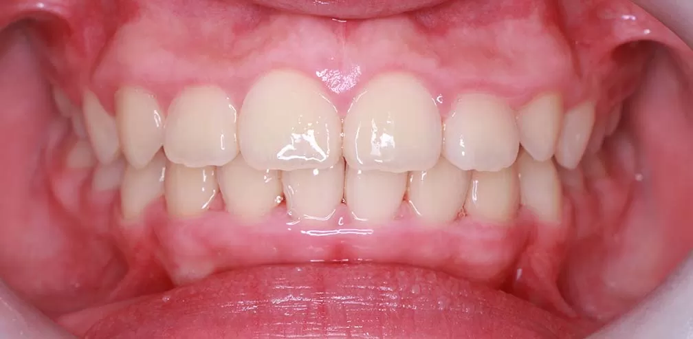 Smartee Kinder-Deep Overjet, 11 ans