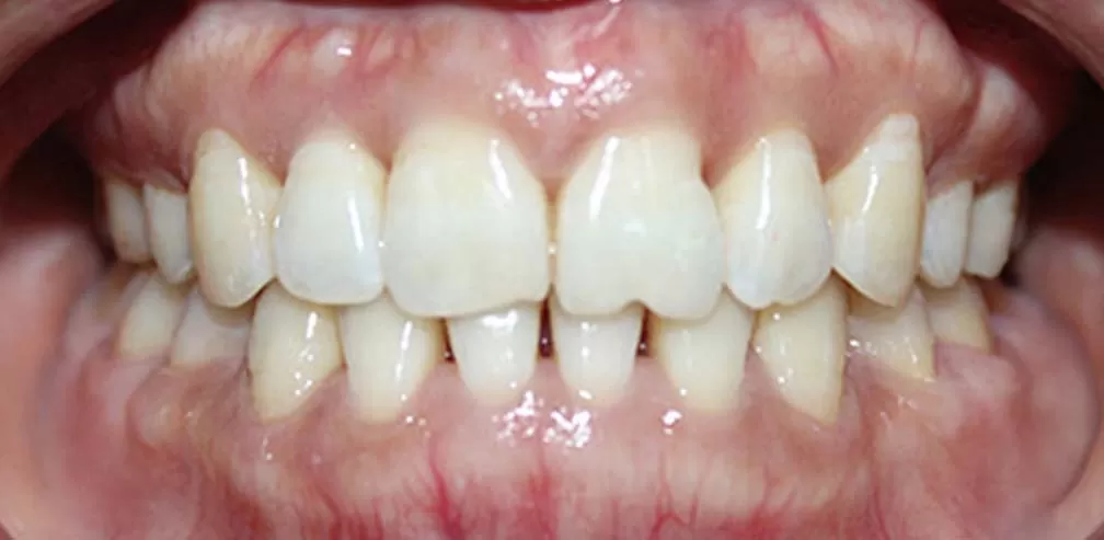 Extraction prépolaire croisées des dents individuelles