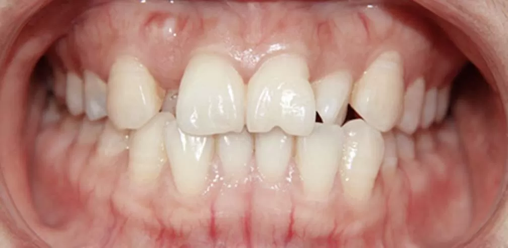 Extraction prépolaire croisées des dents individuelles