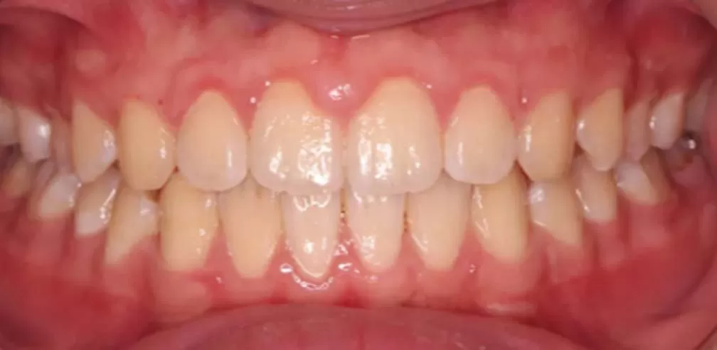 Smartee Teen-Convexité faciale-Rétrusion mandibulaire, 16 ans