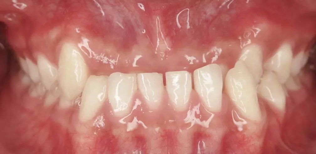 Morsure croisée antérieure