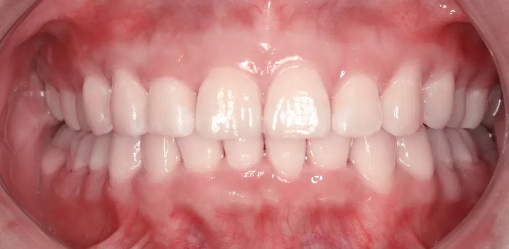 Overbite profonde et Overjet