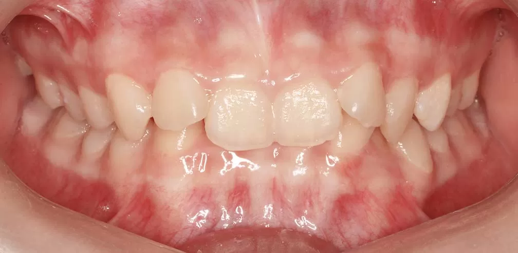 Overbite profonde avec rétroclinaison des dents antérieures