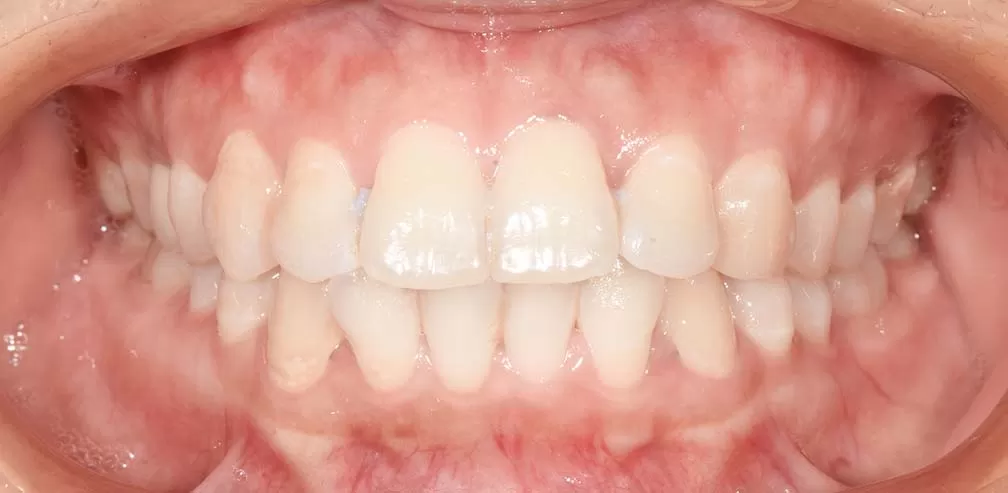 Traitement assisté par TAD pour la protrusion bimaxillaire