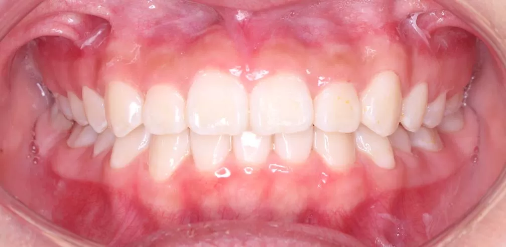 Smartee Teen-Convexité faciale-Rétrusion mandibulaire, femelle de 12 ans