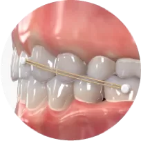 Élastique de classe II